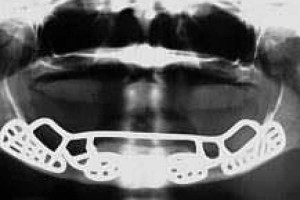 kratok-istorijat-na-evolucijata-na-dentalnata-implantologija_image2