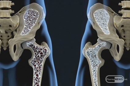 Остеопороза – ризик фактори и превенција